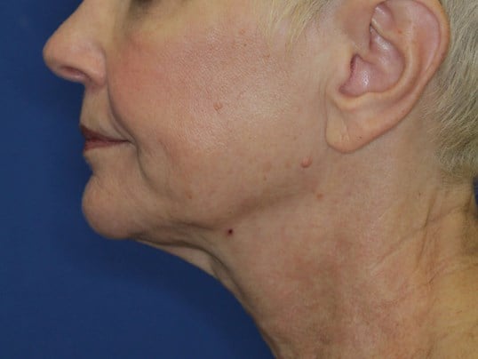 Nonsurgical Skin Tightening After