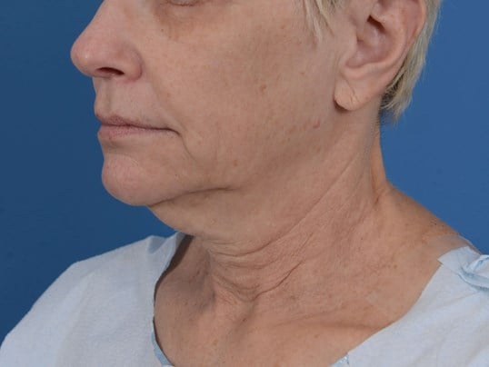 Nonsurgical Skin Tightening Before