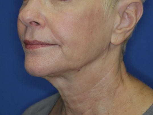 Nonsurgical Skin Tightening After