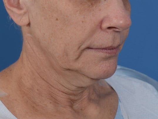 Nonsurgical Skin Tightening Before