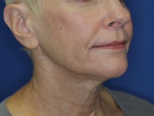 Nonsurgical Skin Tightening After