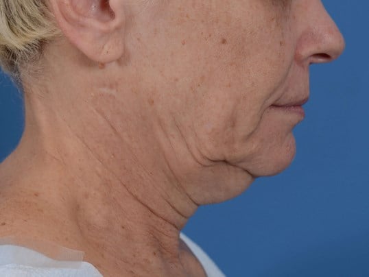 Nonsurgical Skin Tightening Before