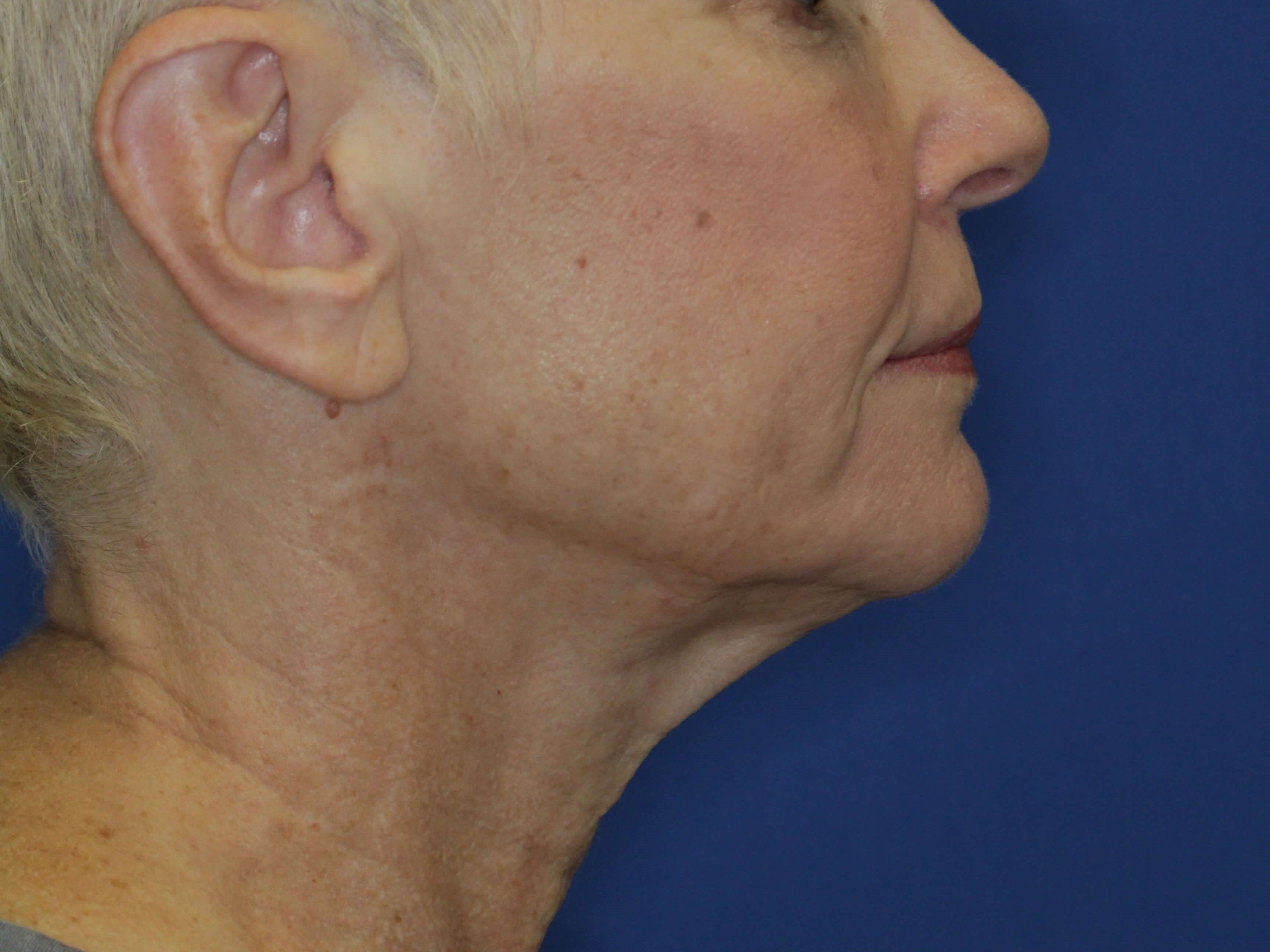 Nonsurgical Skin Tightening After