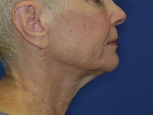 Nonsurgical Skin Tightening After