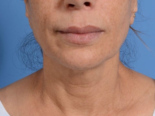 Nonsurgical Jaw Contouring Before