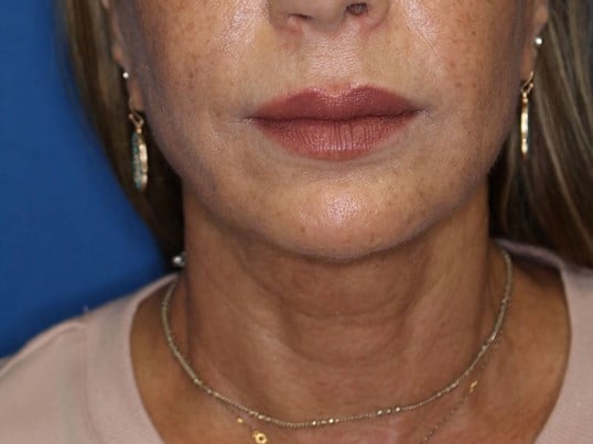 Nonsurgical Jaw Contouring After