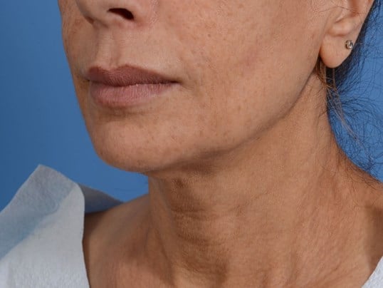 Nonsurgical Skin Tightening Before