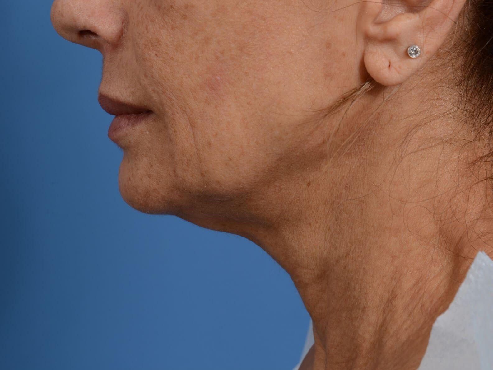 Nonsurgical Jaw Contouring Before