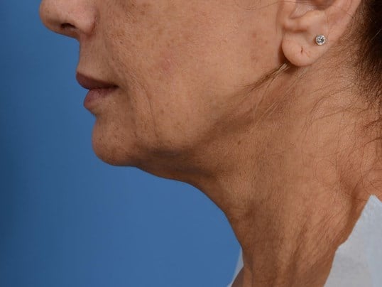 Nonsurgical Jaw Contouring Before