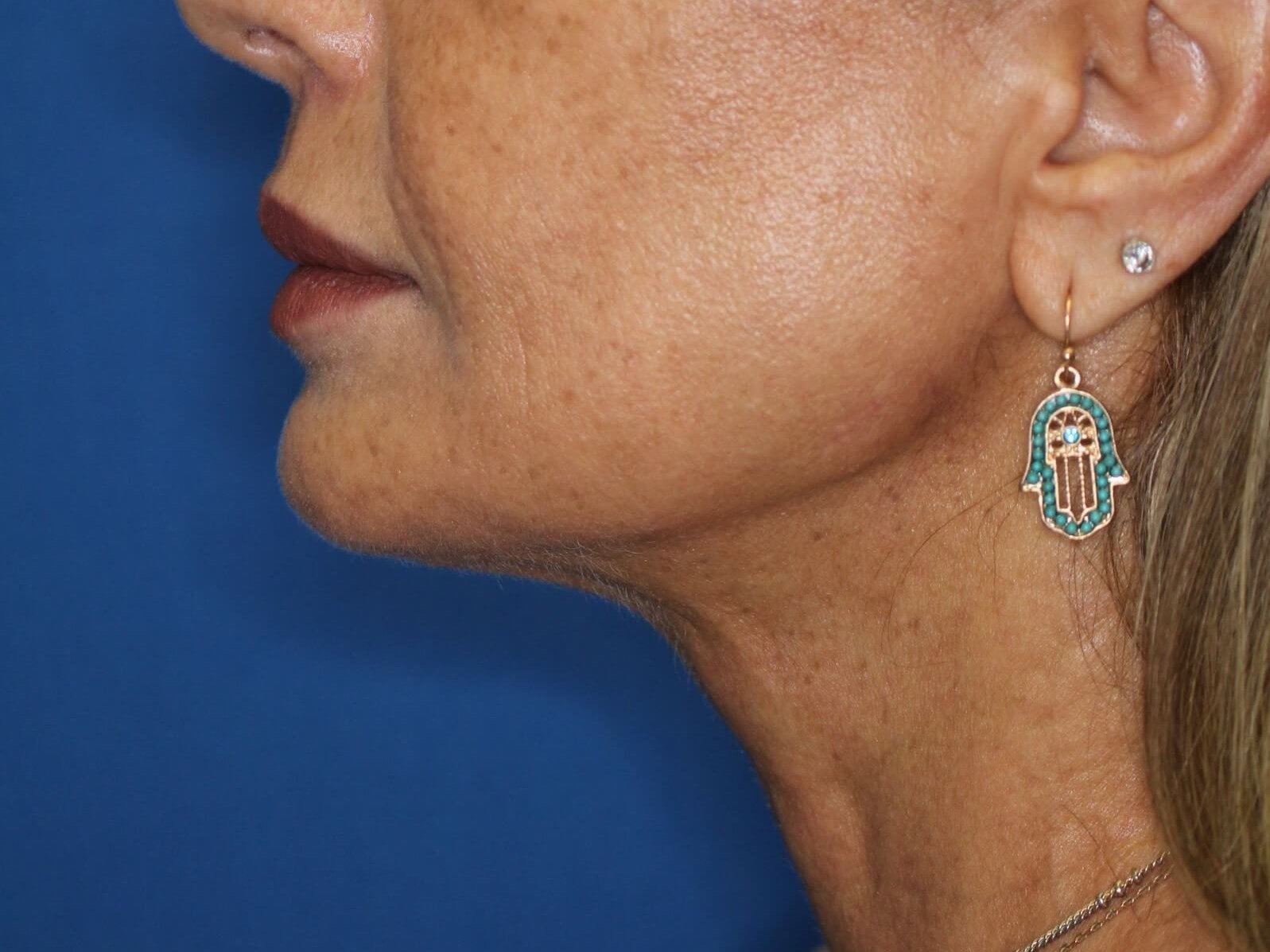 Nonsurgical Jaw Contouring After
