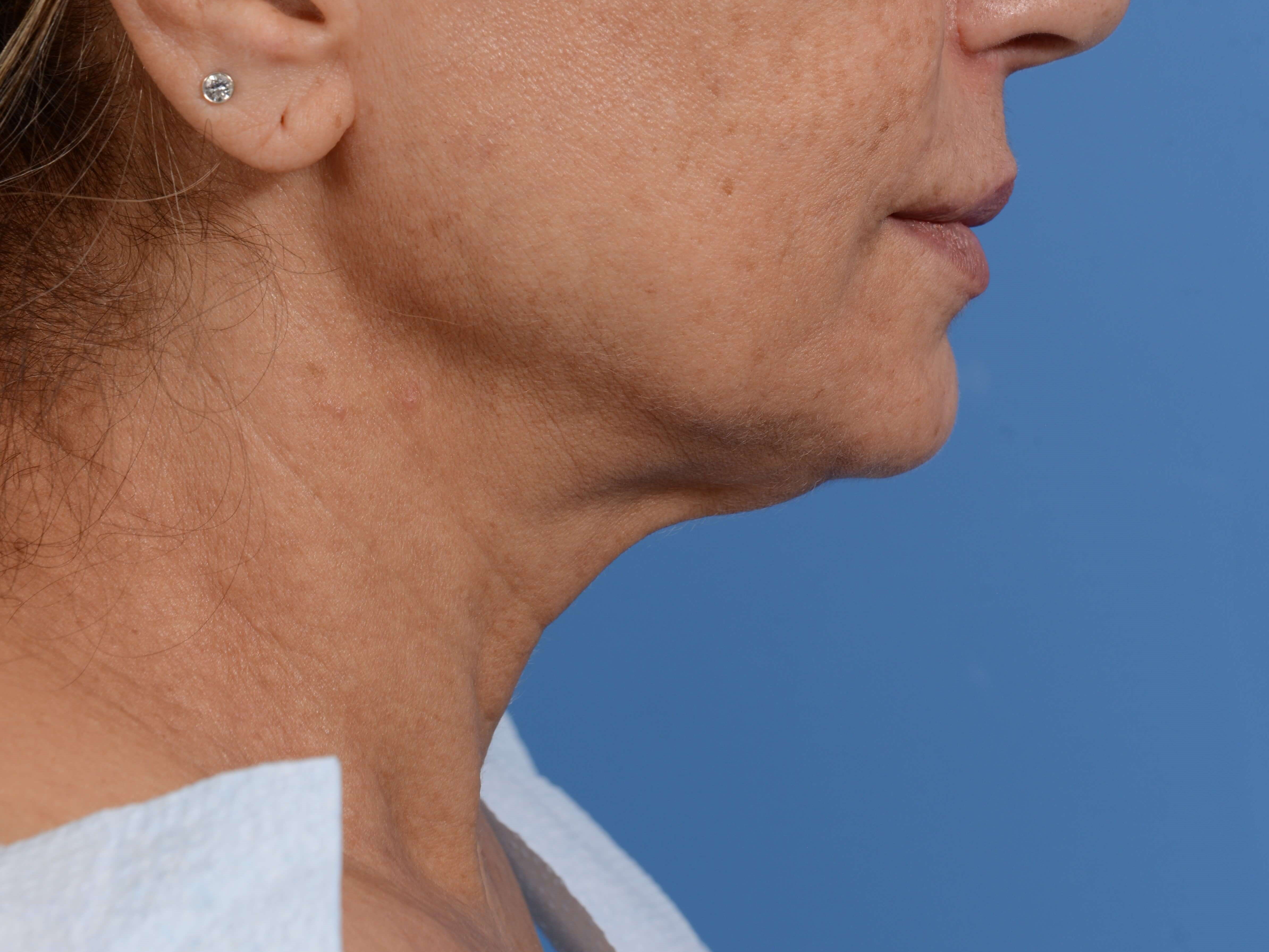 Nonsurgical Jaw Contouring Before