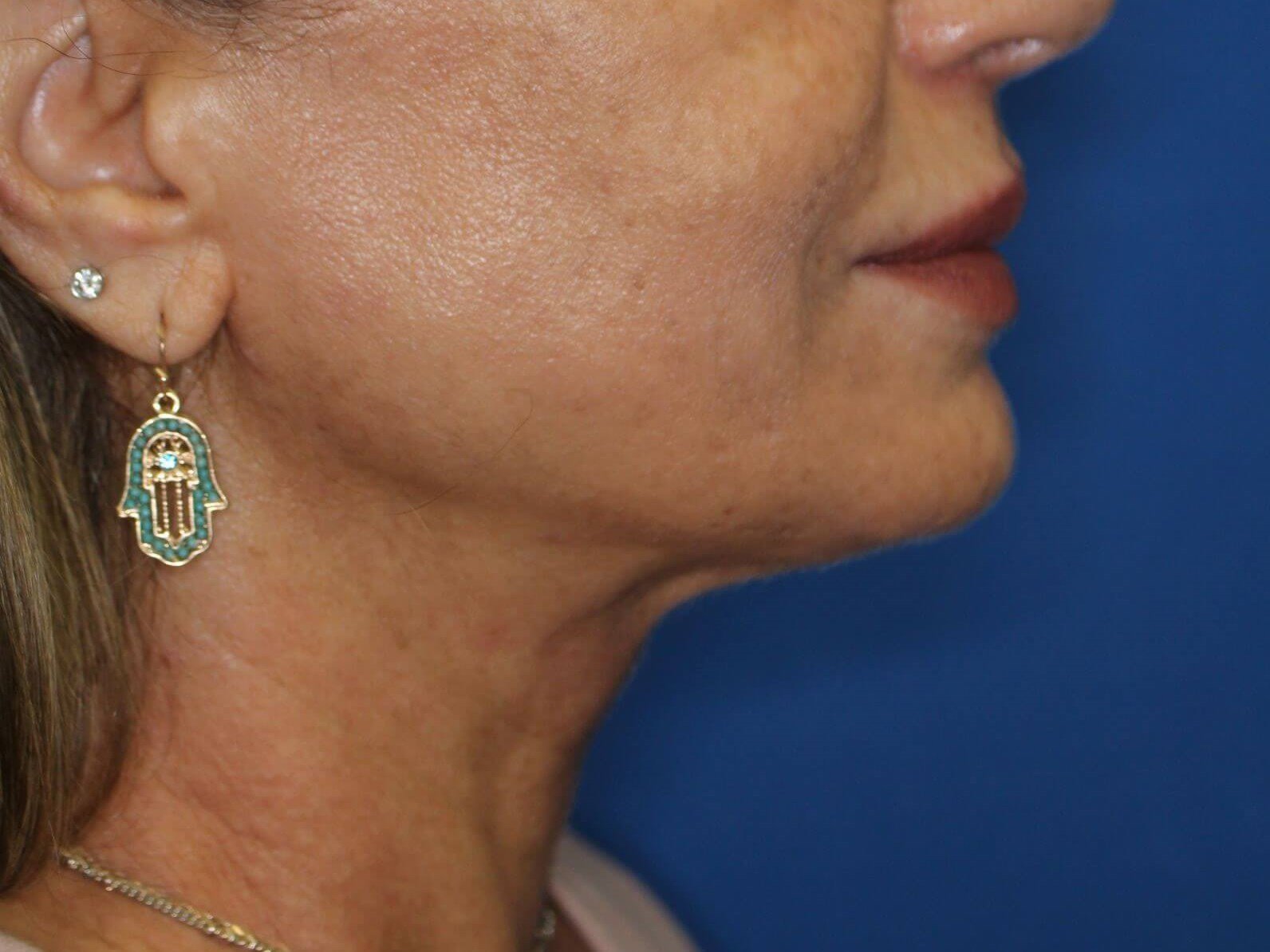 Nonsurgical Jaw Contouring After