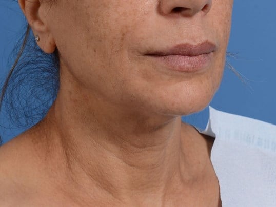 Nonsurgical Skin Tightening Before