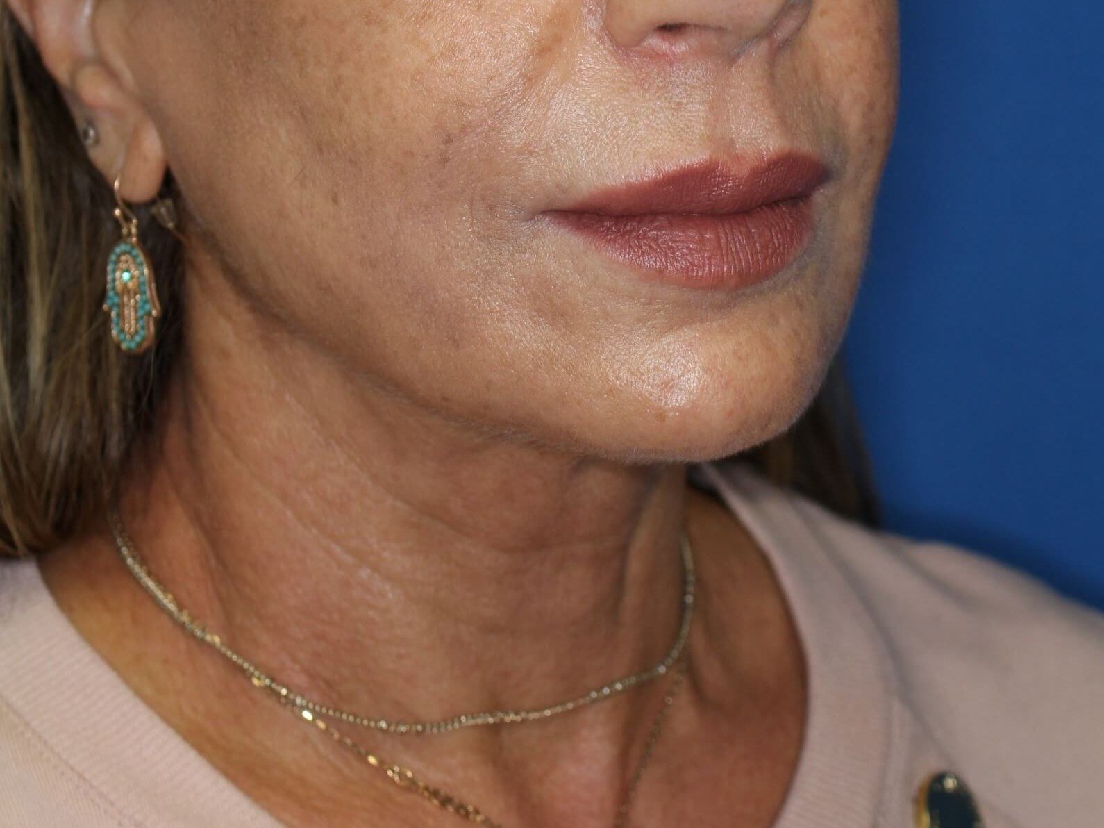 Nonsurgical Skin Tightening After