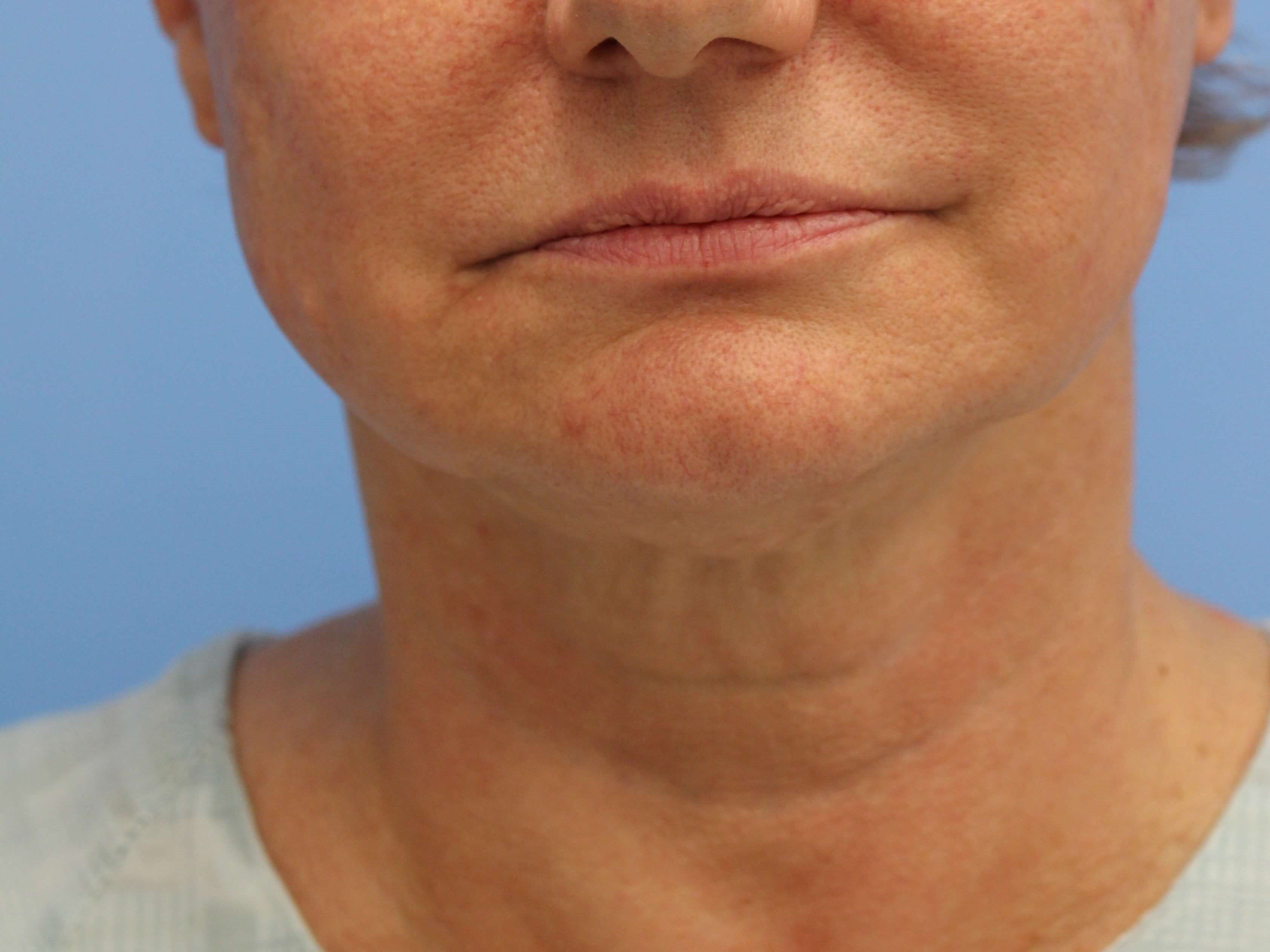 Nonsurgical Skin Tightening Before