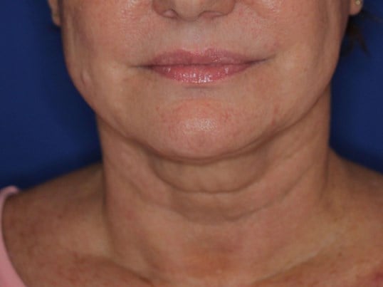 Nonsurgical Skin Tightening After