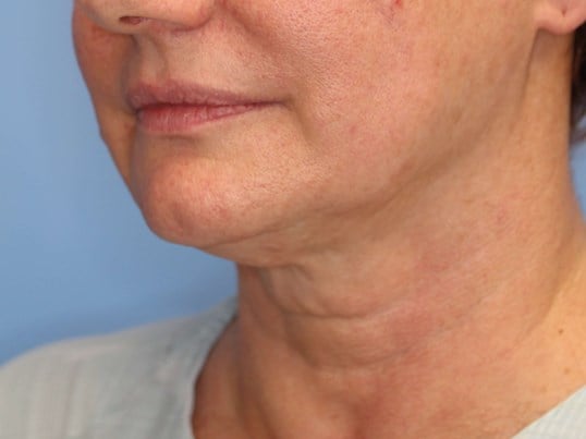 Nonsurgical Skin Tightening Before
