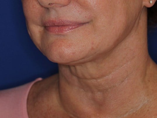 Nonsurgical Skin Tightening After