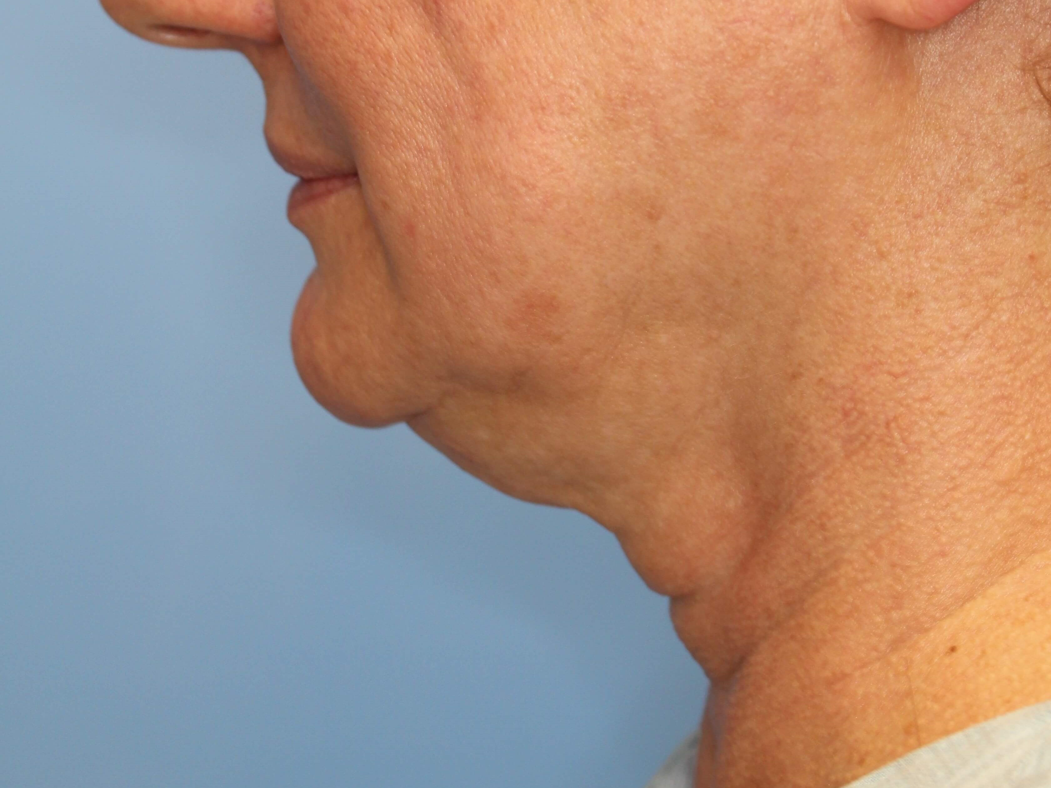 Nonsurgical Skin Tightening Before