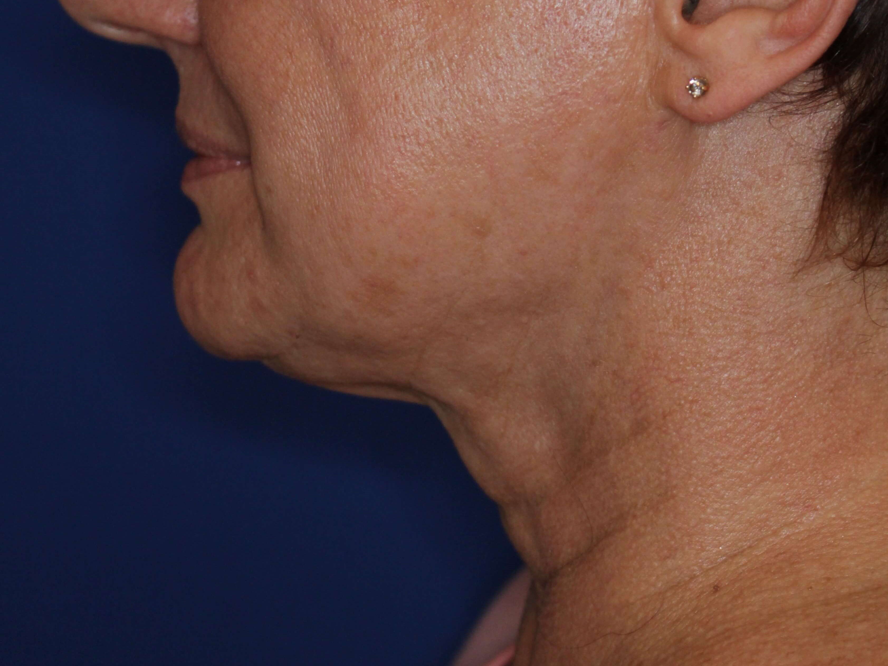 Nonsurgical Skin Tightening After