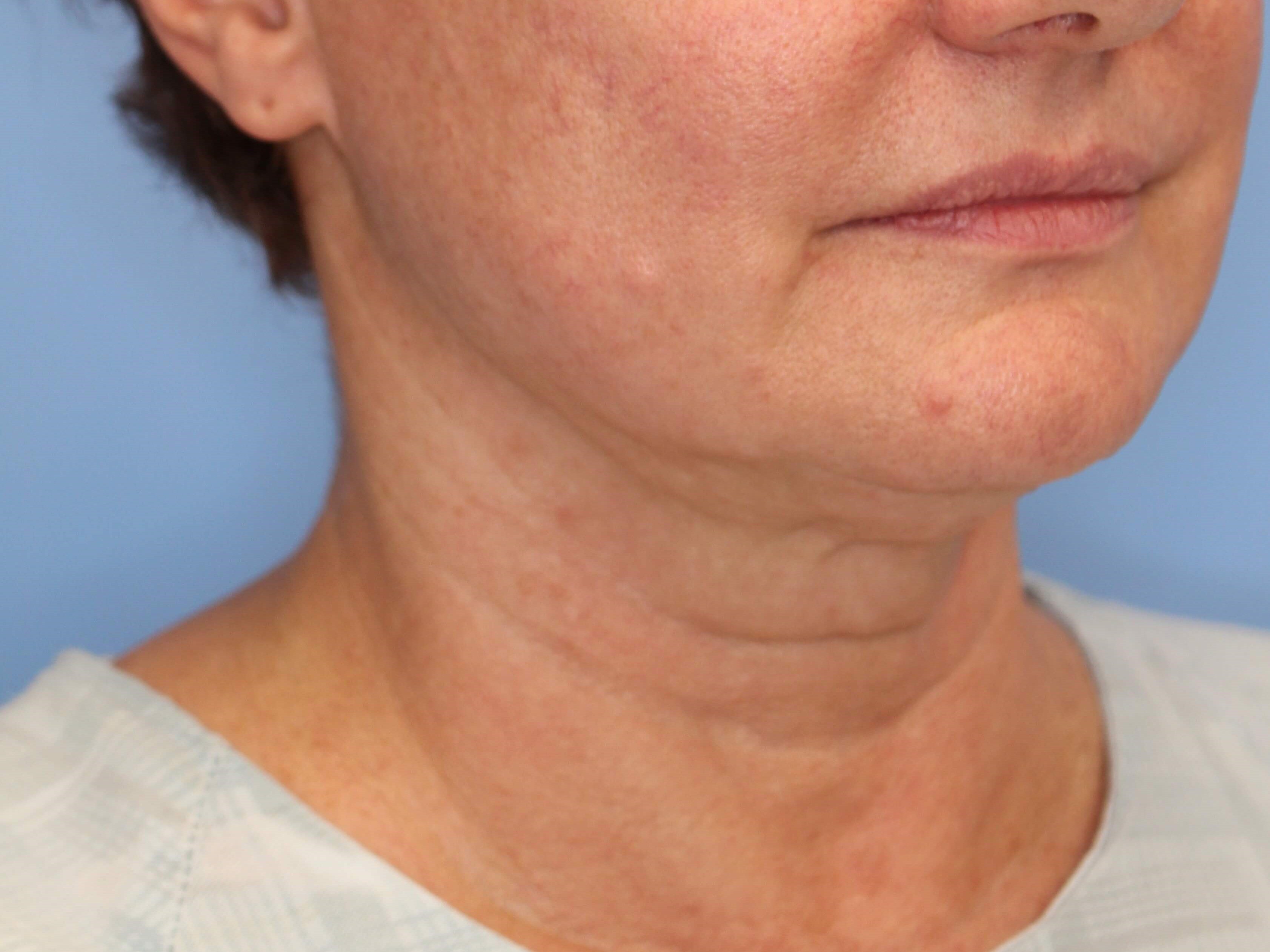Nonsurgical Skin Tightening Before