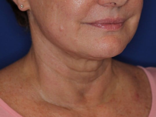 Nonsurgical Skin Tightening After
