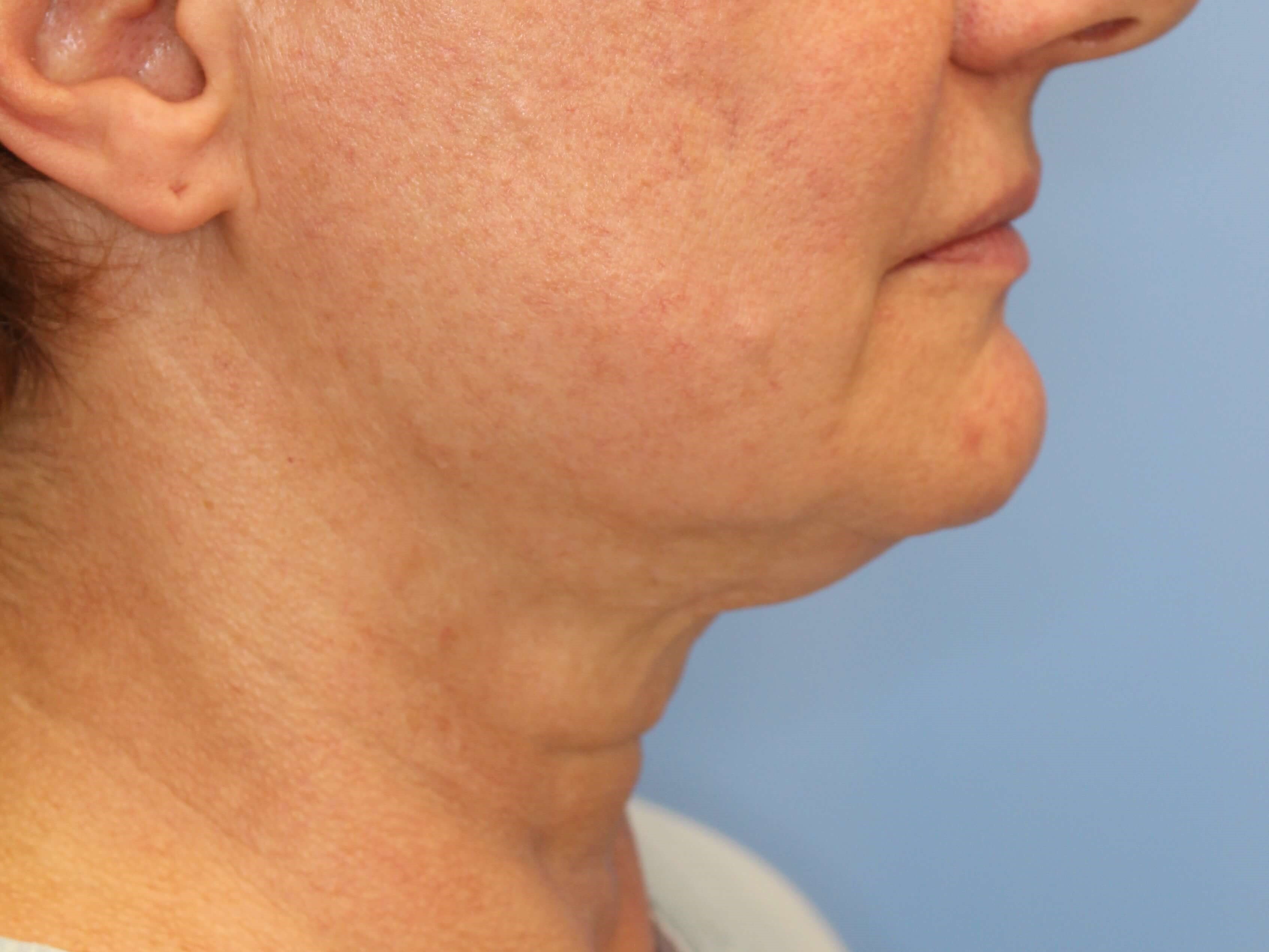 Nonsurgical Jaw Contouring Before