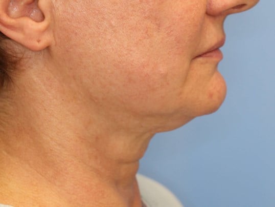 Nonsurgical Jaw Contouring Before