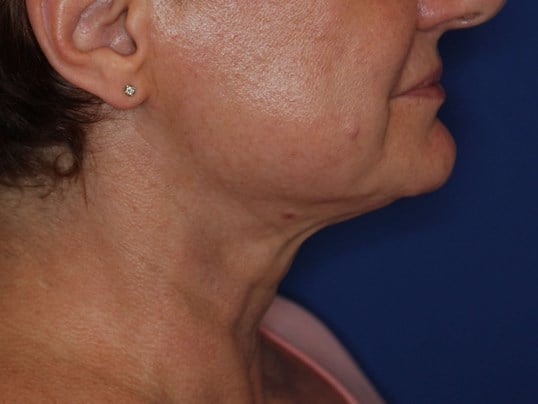 Nonsurgical Jaw Contouring After