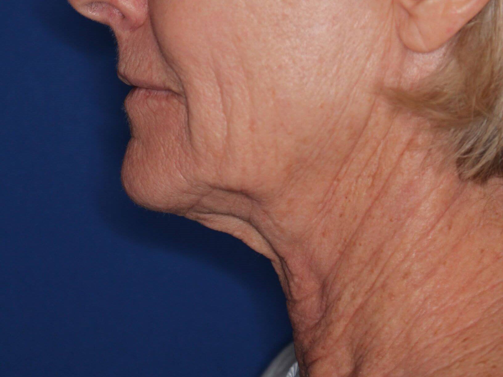 Nonsurgical Skin Tightening Before