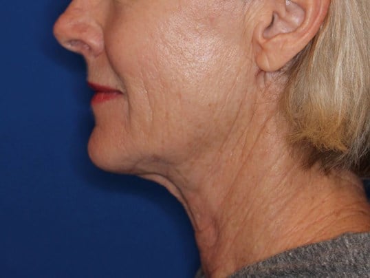 Nonsurgical Skin Tightening After