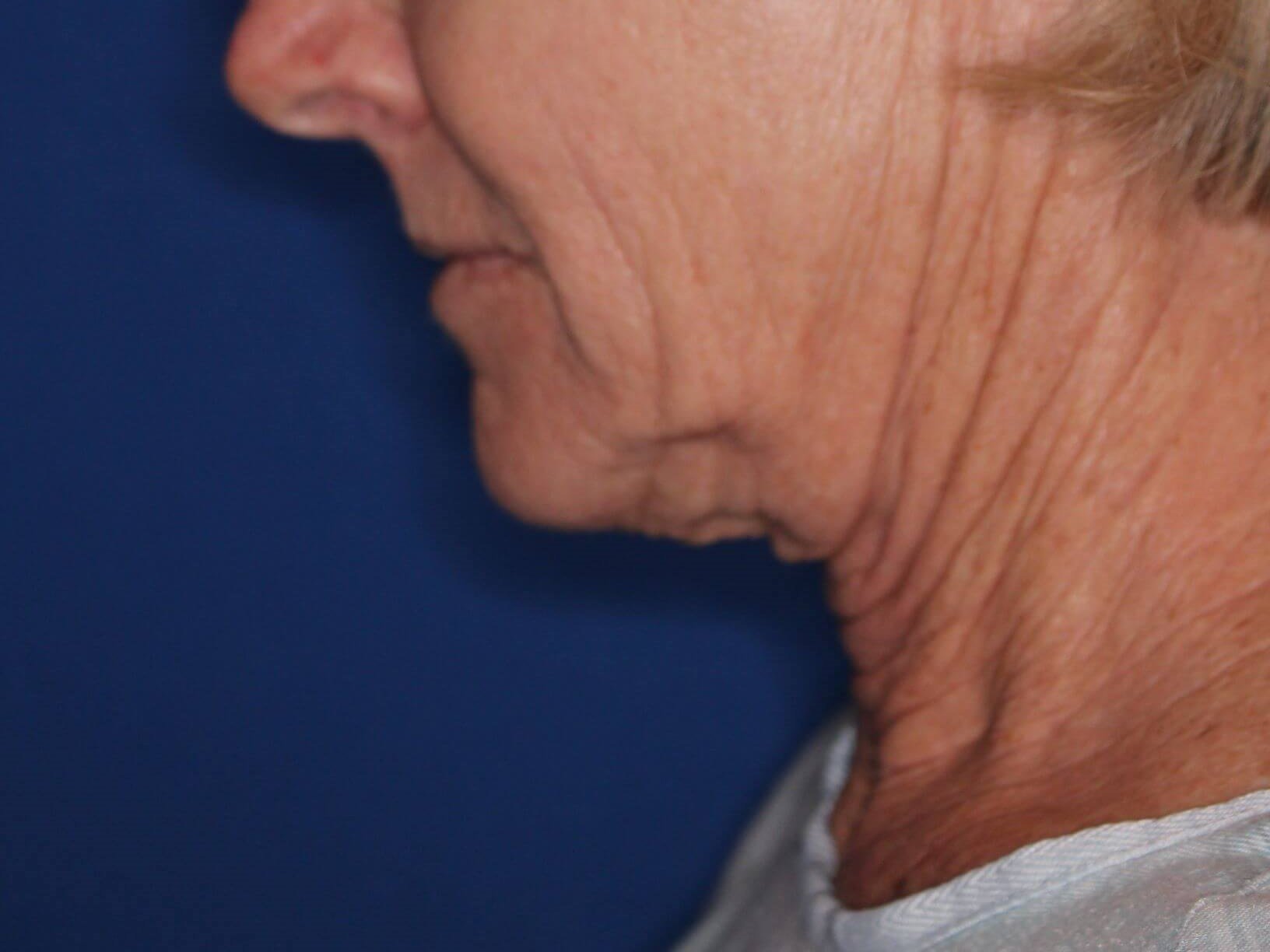 Nonsurgical Skin Tightening Before