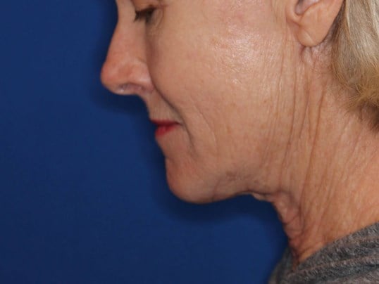Nonsurgical Skin Tightening After
