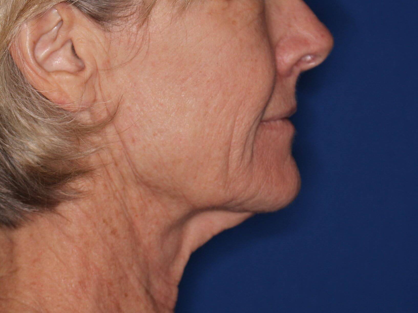 Nonsurgical Skin Tightening Before