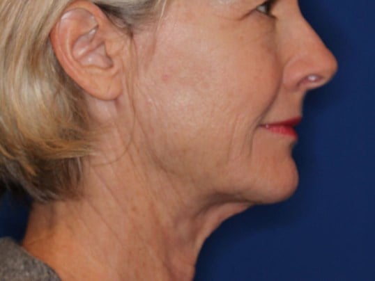 Nonsurgical Skin Tightening After