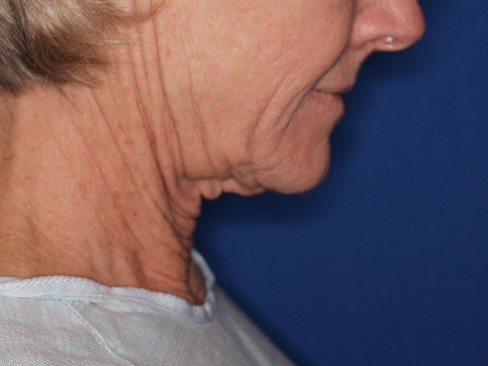 Nonsurgical Skin Tightening Before