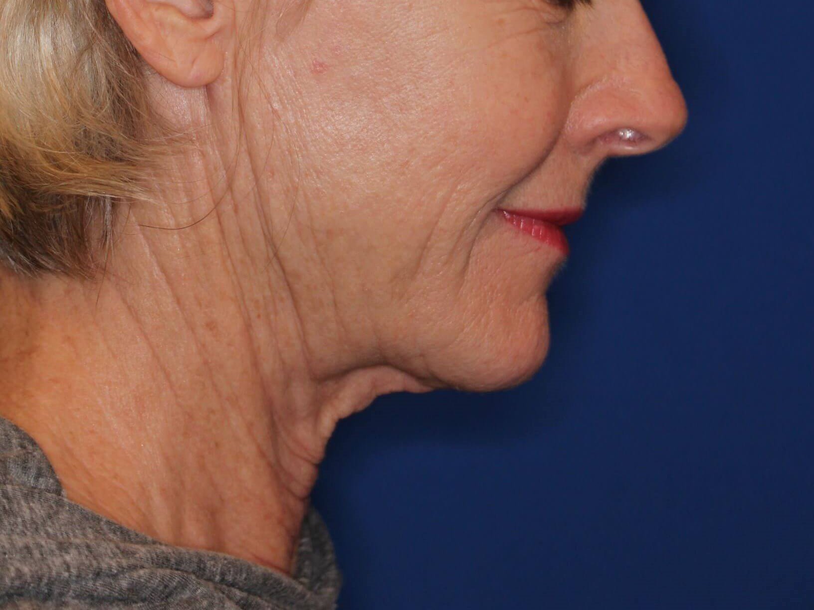 Nonsurgical Skin Tightening After