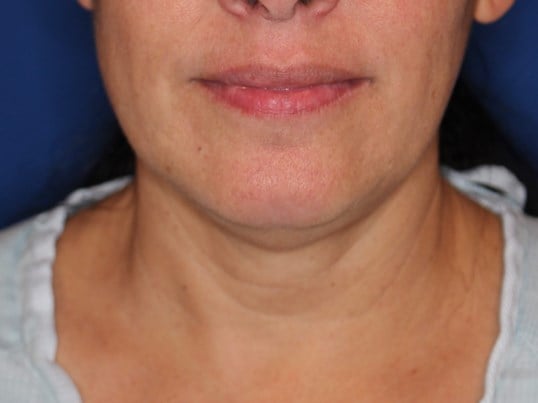 Nonsurgical Skin Tightening Before