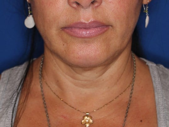 Nonsurgical Skin Tightening After