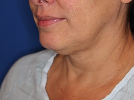 Nonsurgical Jaw Contouring Before
