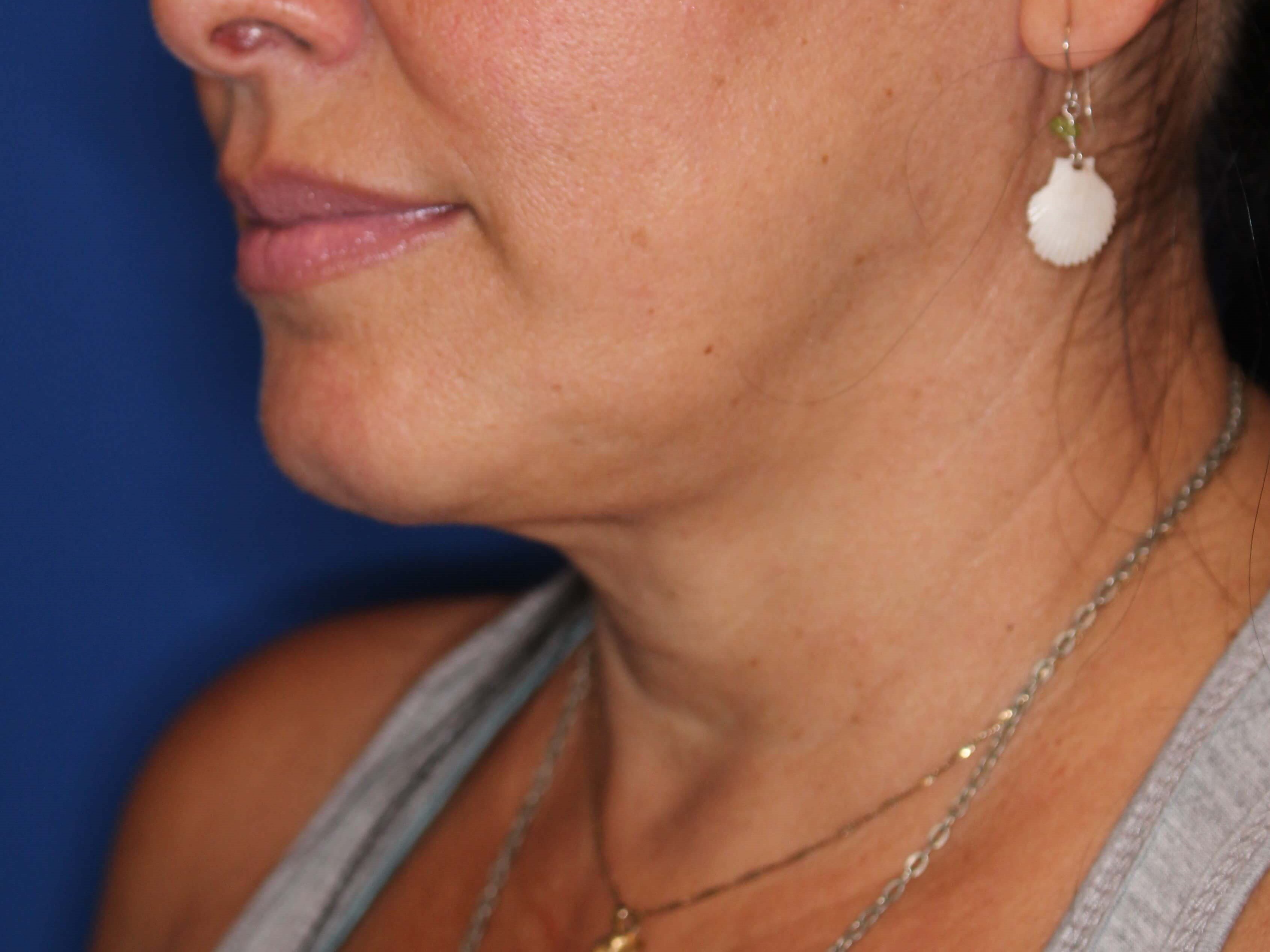 Nonsurgical Jaw Contouring After