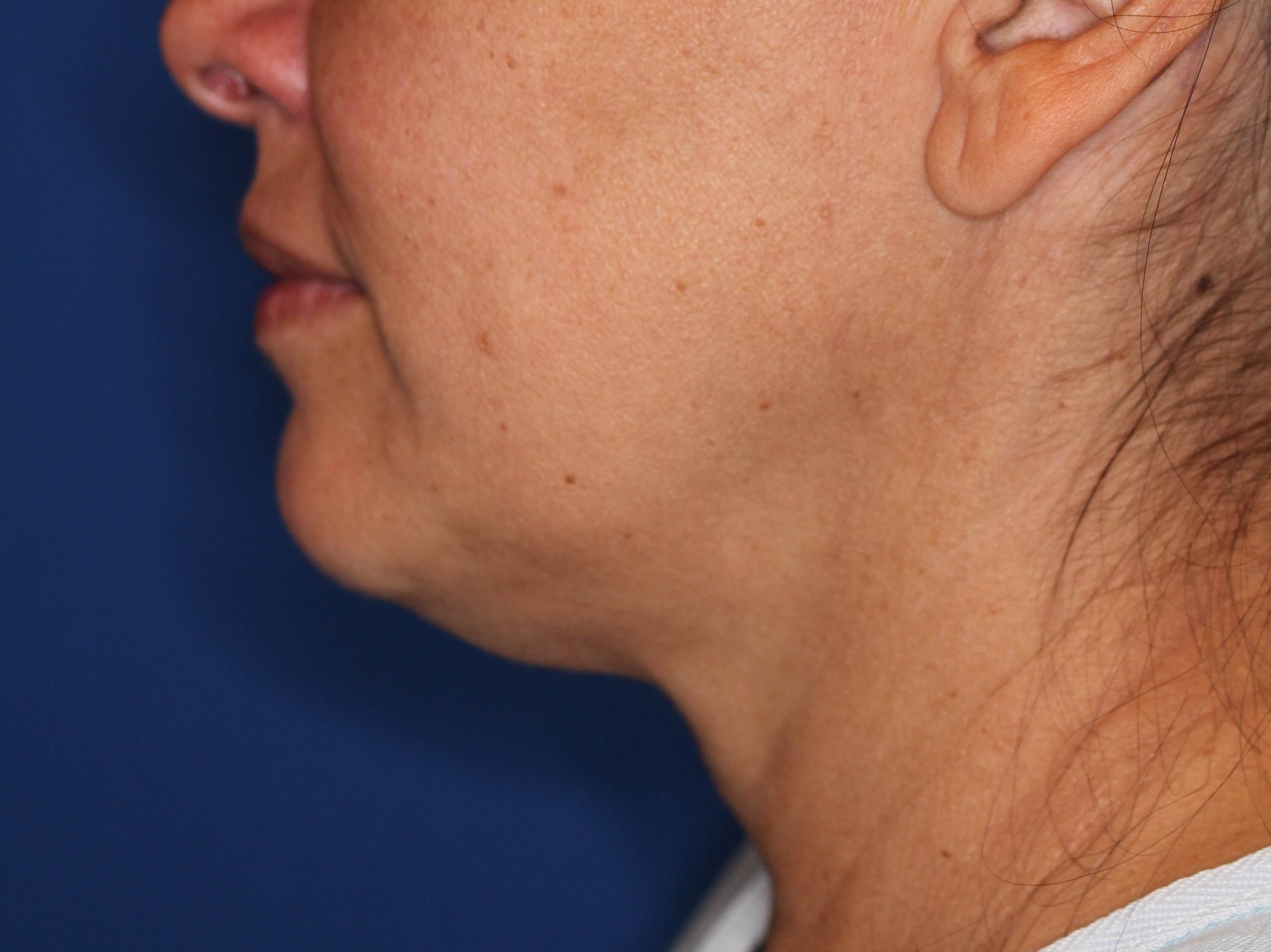 Nonsurgical Jaw Contouring Before