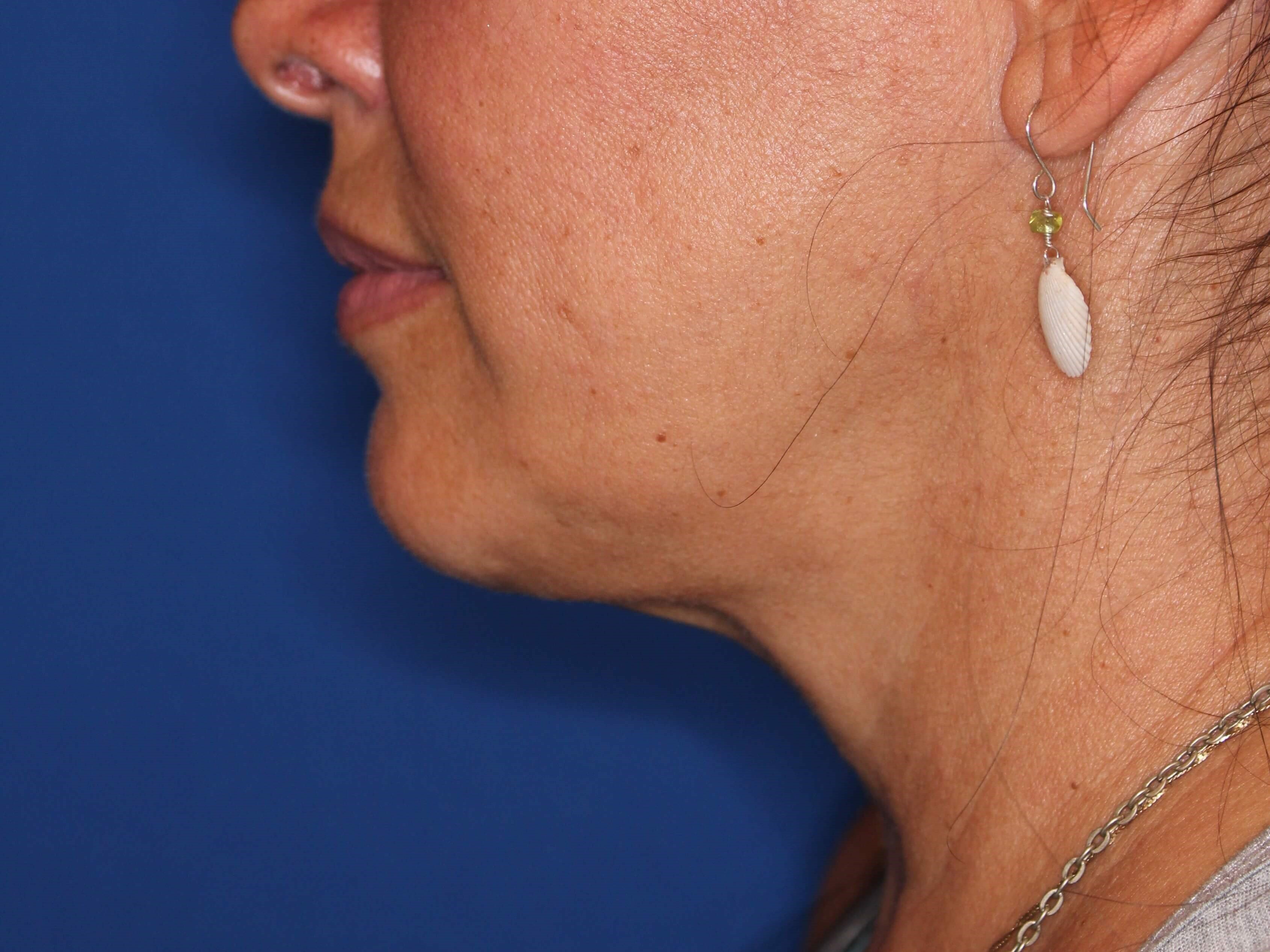 Nonsurgical Jaw Contouring After