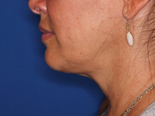 Nonsurgical Jaw Contouring After