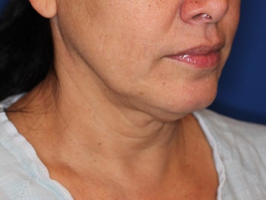 Nonsurgical Jaw Contouring Before