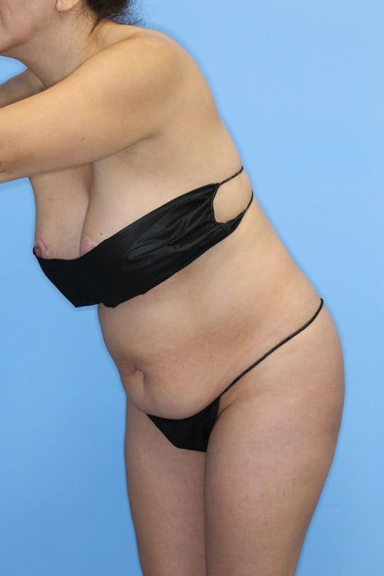 Awake Liposuction of Abdomen Before
