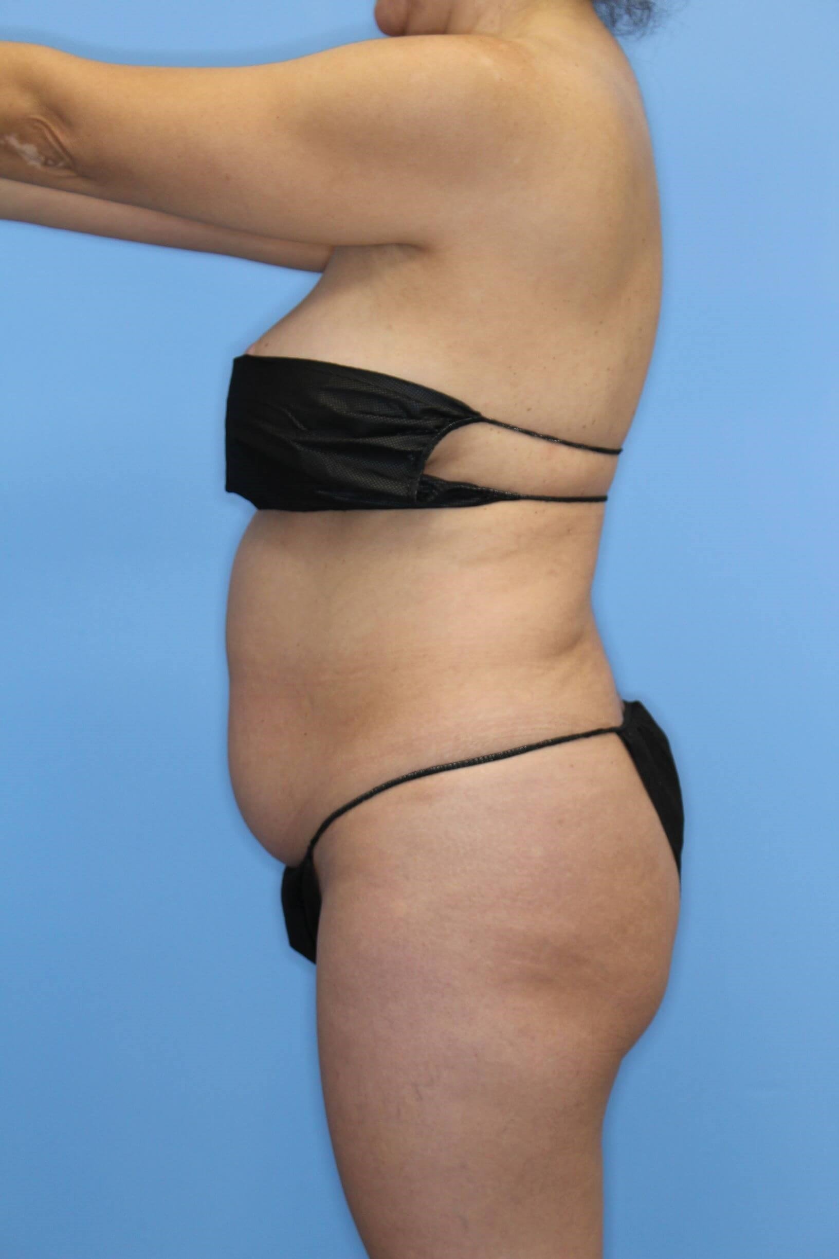 Awake Liposuction of Abdomen Before
