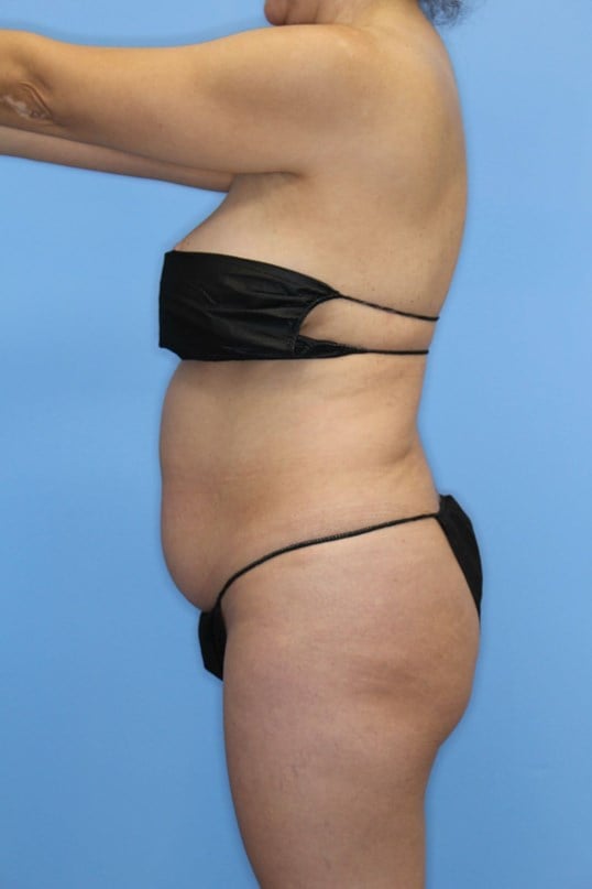 Awake Liposuction of Abdomen Before