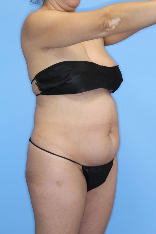 Awake Liposuction of Abdomen Before