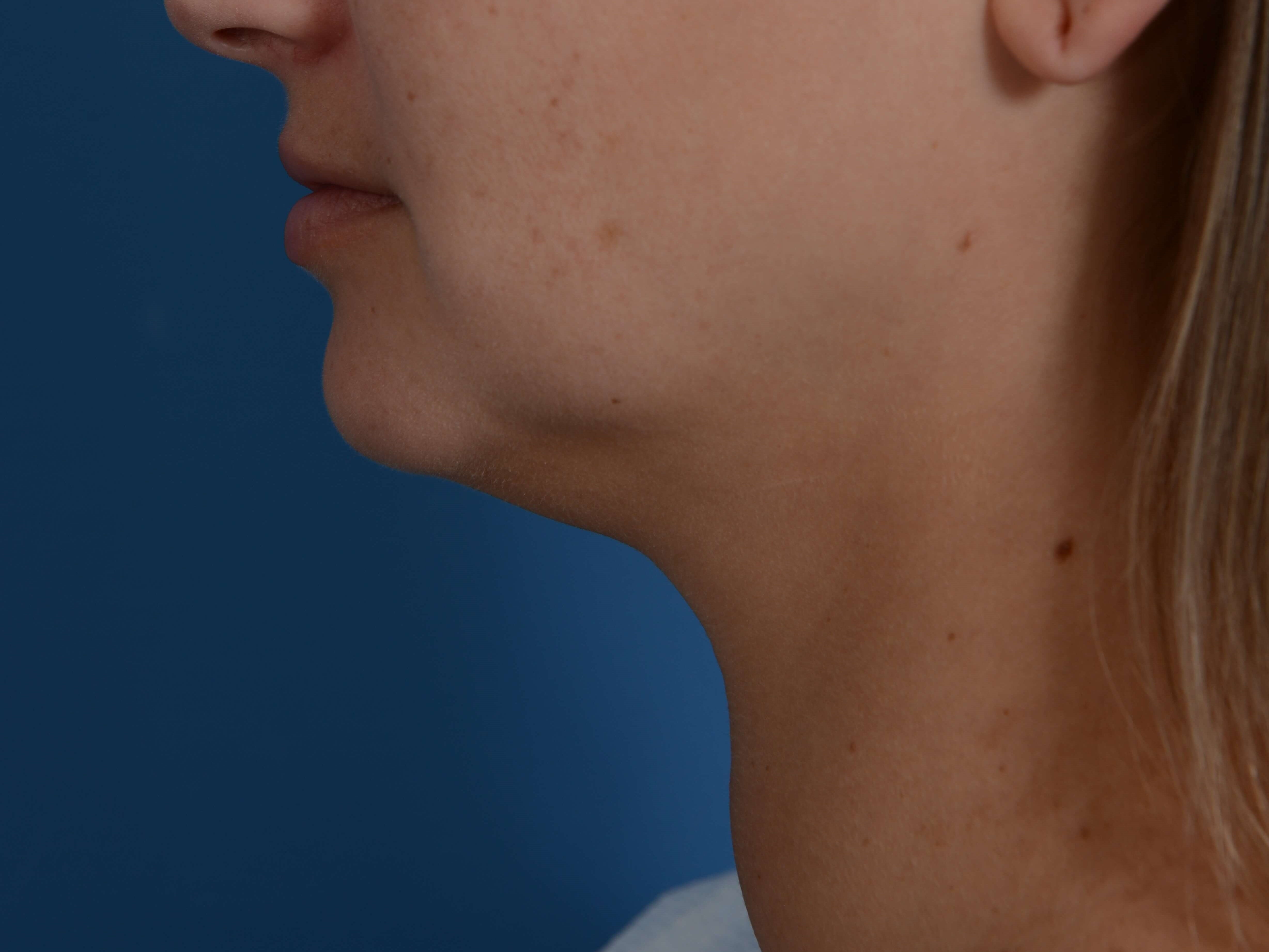Neck Liposuction Before